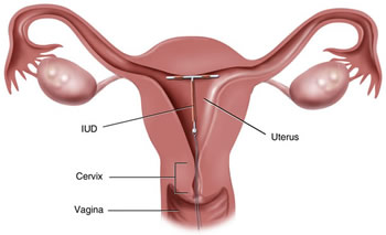 IUD contraception